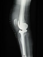 Knie